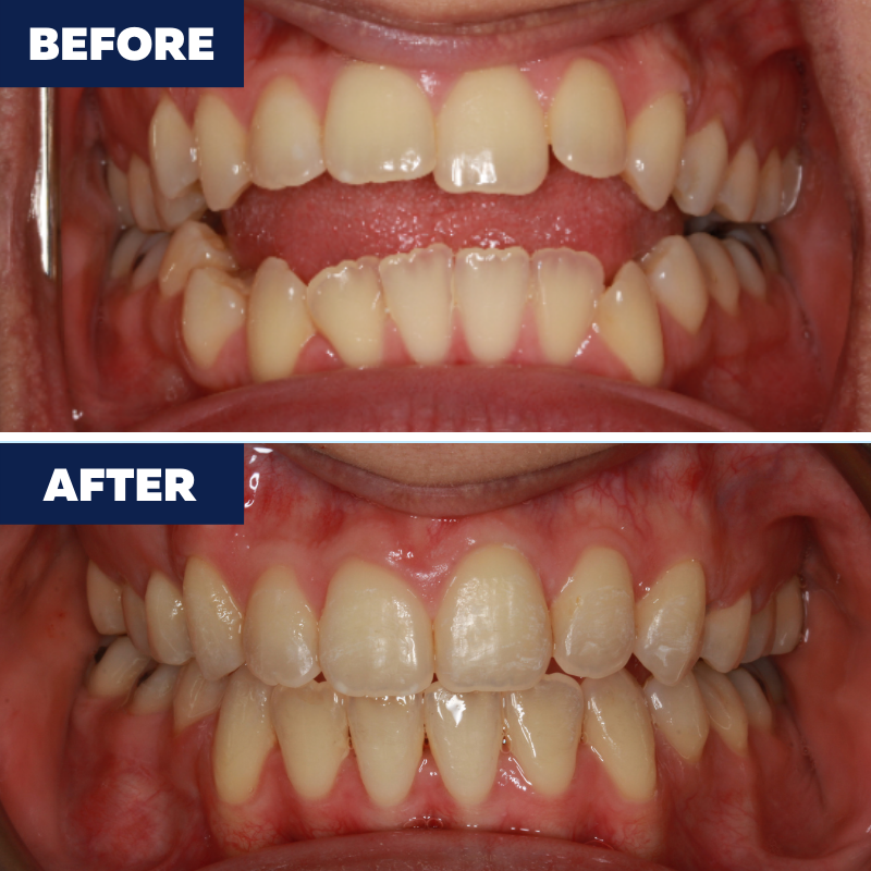 Open bite treated braces 24 months. Call us to schedule a consultation!	(424) 317-7707 https://ortho Orthodontics of Torrance Torrance (424)201-0712