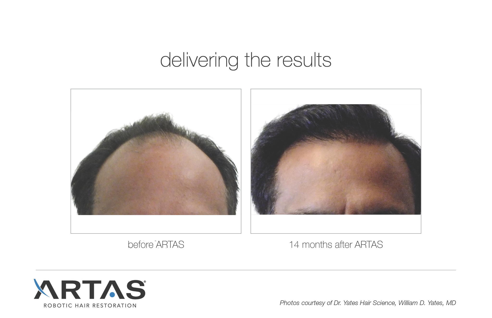 Images Follicl MD - Hair transplant - Greffe de cheveux