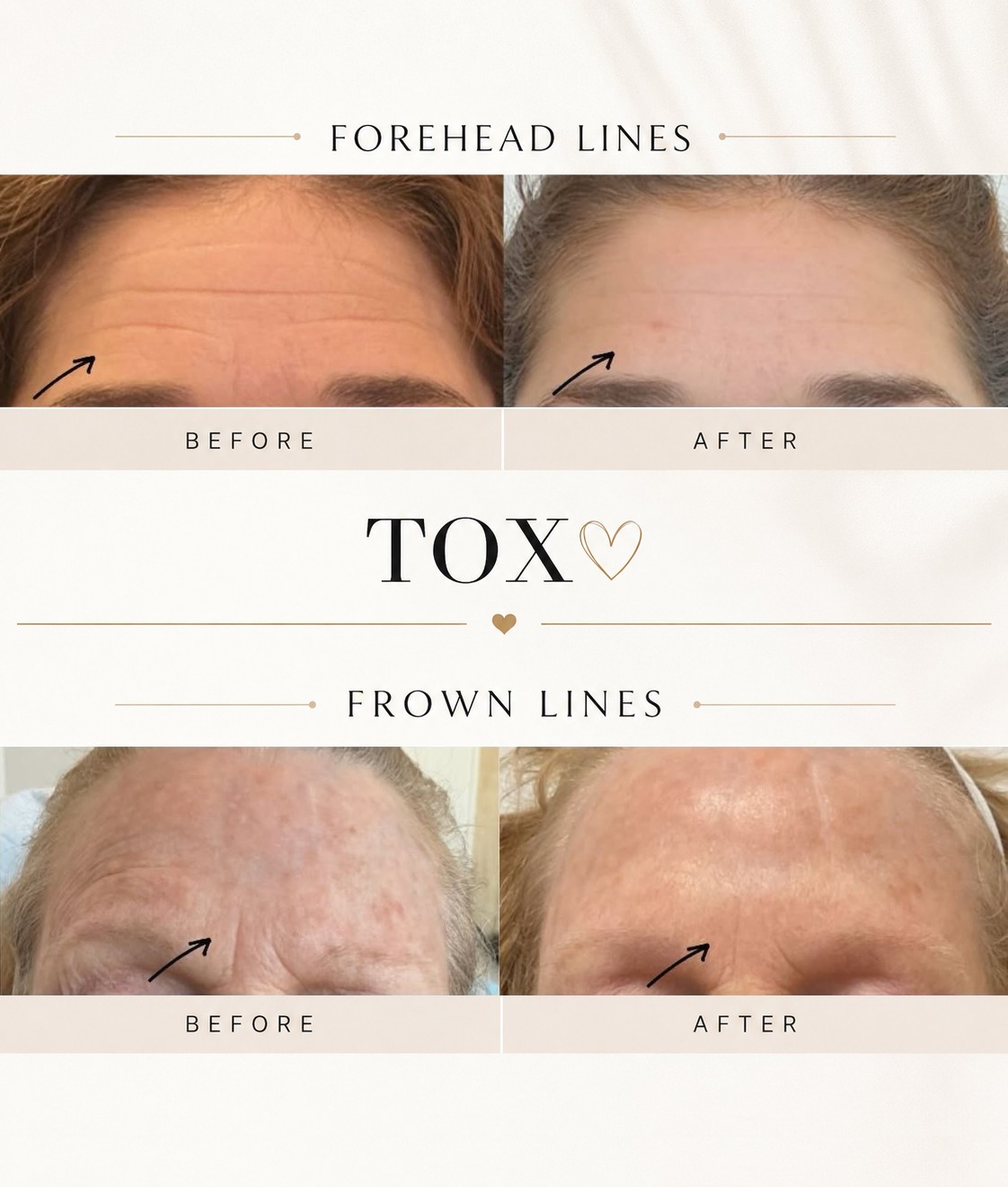 Before and after Botox results for forehead lines and frown lines at RAVE Clinics in Littleton, CO.