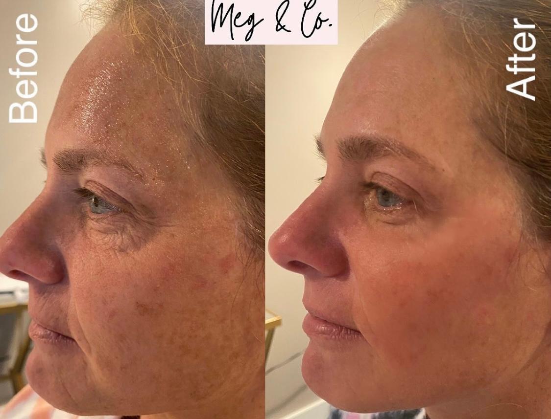 Before and after Total Skin Solutio (Genius Radio Frequency microneedling and LaseMD Ultra)