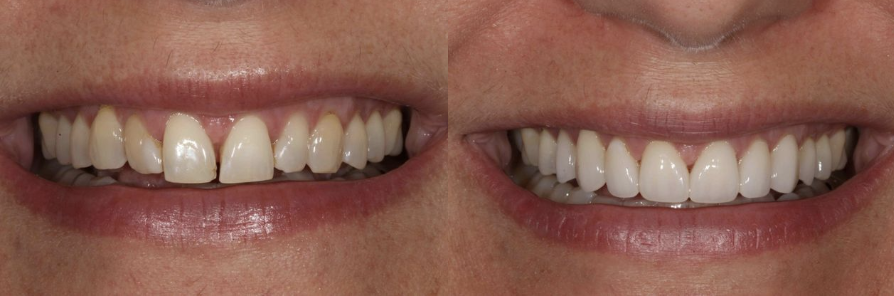 Before & After Results of Advanced Dentistry of Blakeney | Charlotte, NC