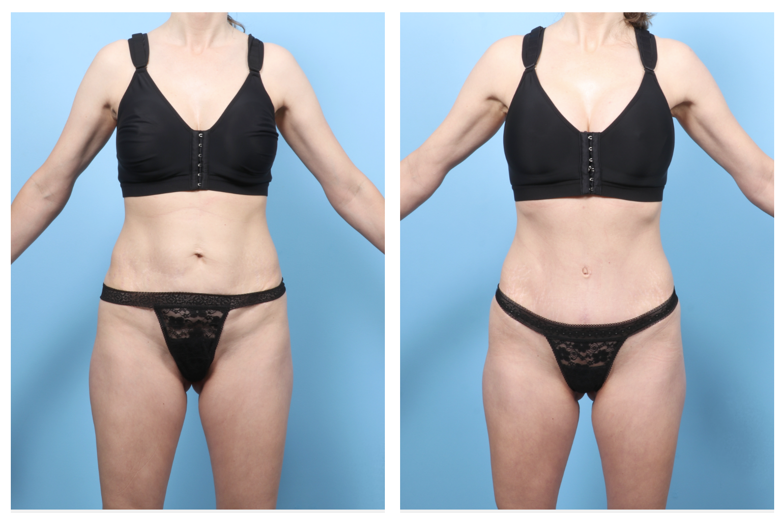 Dr. Drew Davis Sacramento Tummy Tuck 