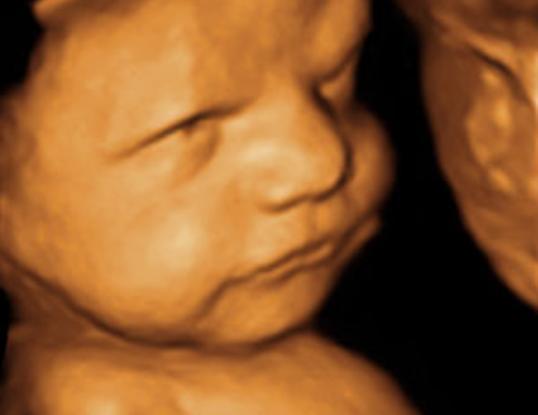 3D 4D Ultrasound 