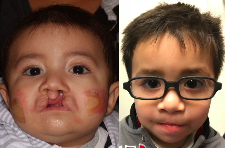 Before and After Bilateral Cleft Lip Repair