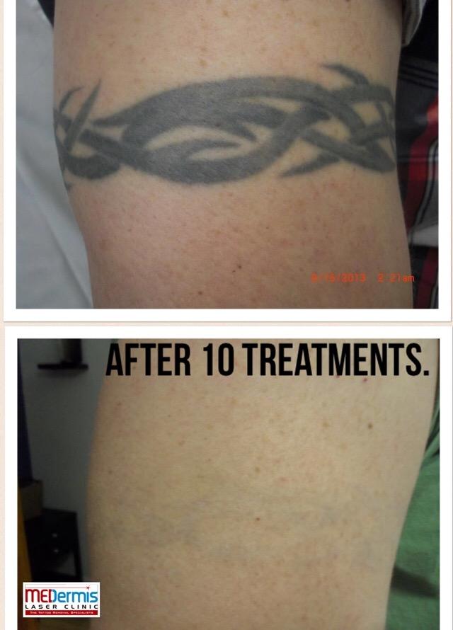 medermis laser tattoo removal in san antonio tx 78258 medermis laser tattoo removal in san antonio tx 78258