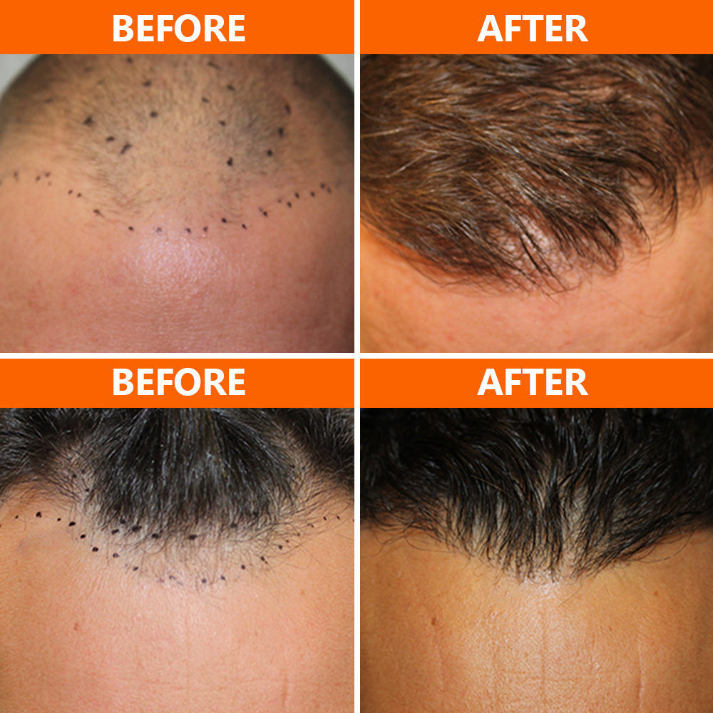 PRP hair treatment in San Diego helps restore and stimulate hair growth by injecting your natural occurring blood platelets into the area(s) of your scalp where there is hair loss. PRP hair restoration therapy can help regenerate your hair follicles without the need for surgery.