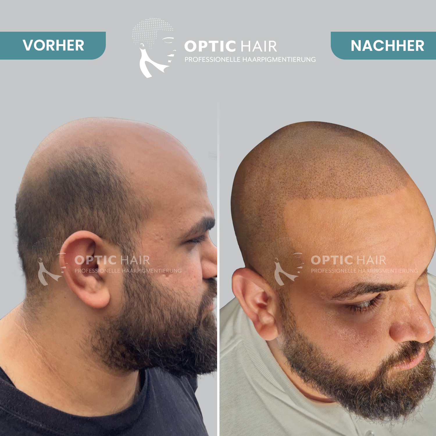 Haarpigmentierung Köln OpticHair in Köln - Logo