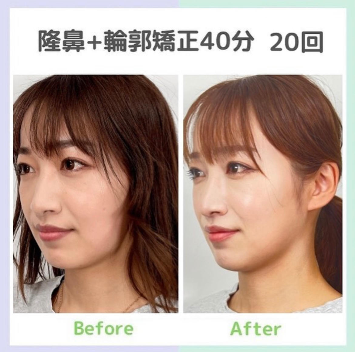 Images 隆鼻矯正専門店 Raplit 福岡博多店 (ラプリ)