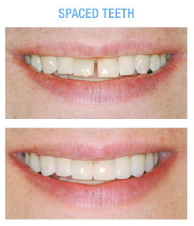 Express smile atlanta coupon code