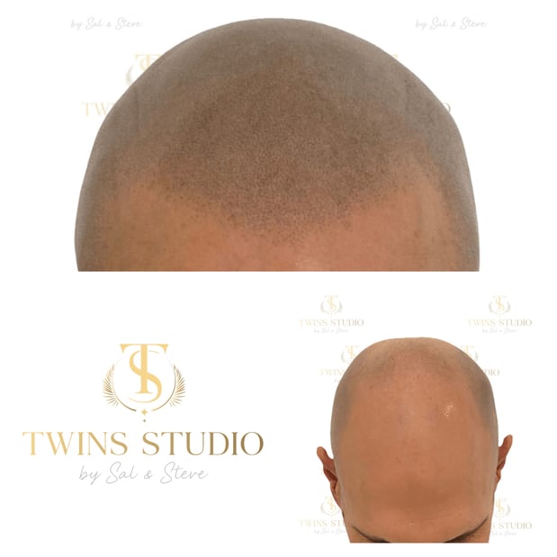 Images Twins Studio (Scalp Micropigmentation - SMP)