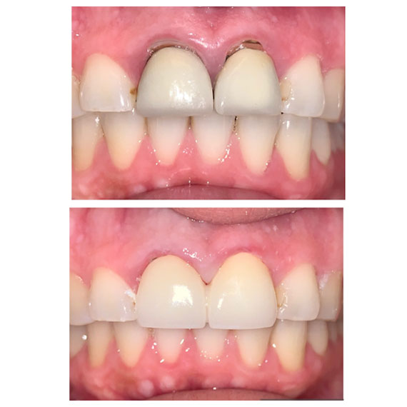 Cortes Family Dentistry-Carillas