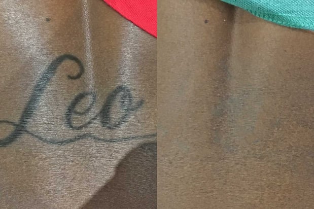 Images TakeTatt Tattoo Removal