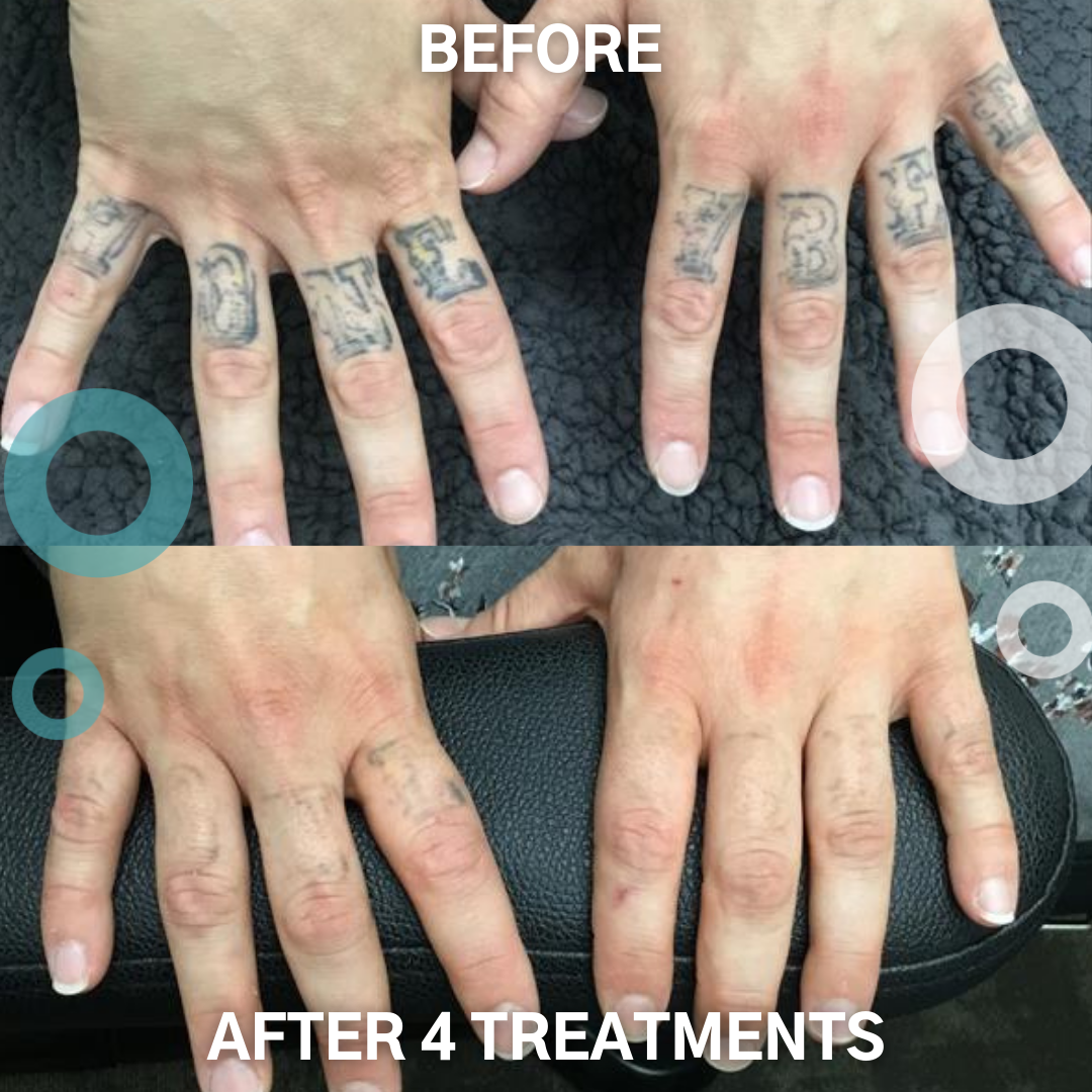 Removery Tattoo Removal & Fading à Ottawa: Before & After Knuckle Tattoo Removal