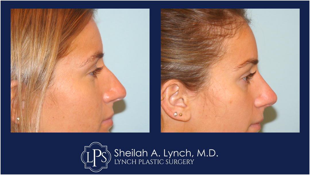 Rhinoplasty, Nose Reshaping Before & After Patient Chevy Chase Maryland. Plastic Surgeon Near Me Sheilah A. Lynch, MD