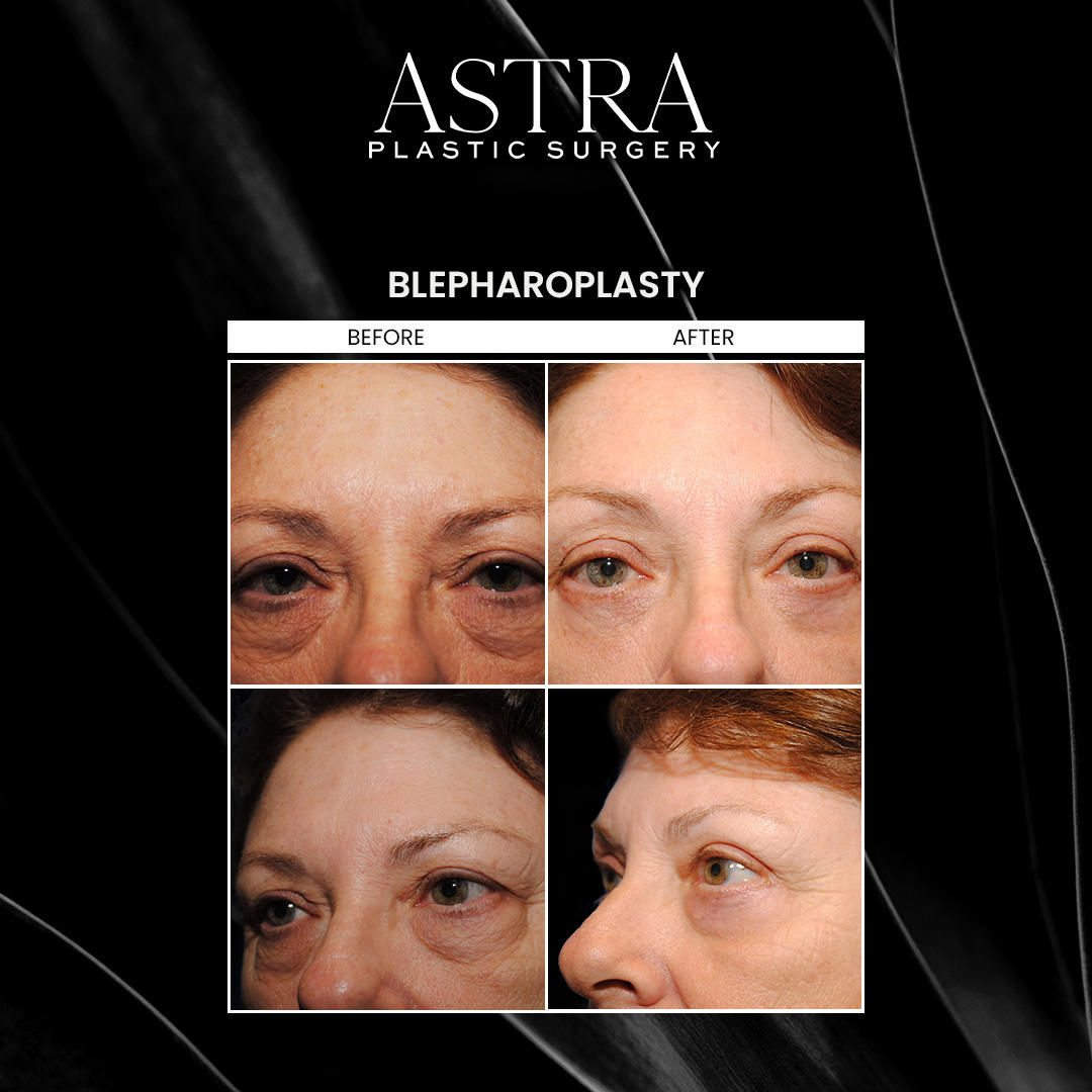 Eyelid surgery, also known as blepharoplasty, can correct the signs of facial aging around the eyes. The signs of aging include crow’s feet, undereye bags, puffiness, drooping eyelids, dark circles, and more. Puffy eyelids can also interfere with your eyesight, obstructing your vision. Patients can achieve a refreshed, youthful expression following eyelid surgery.