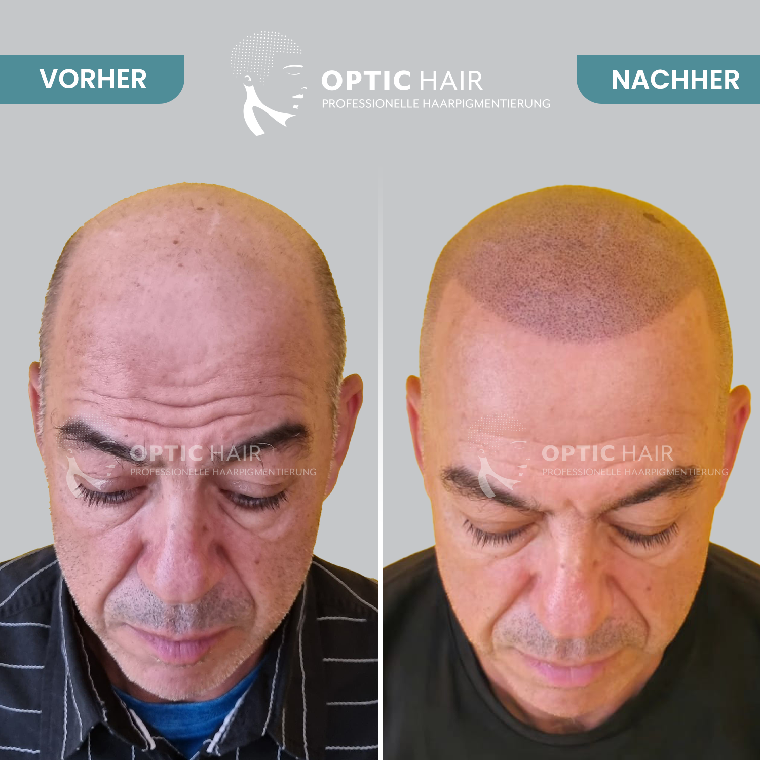 Kundenbild groß 3 Haarpigmentierung Köln | OpticHair