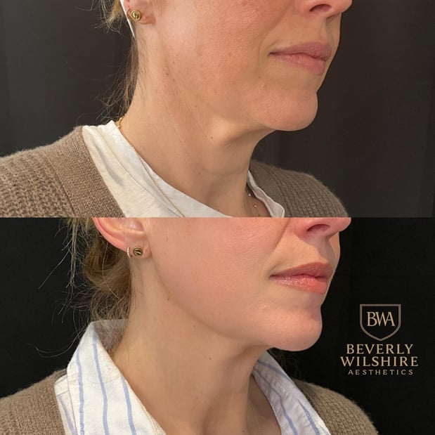 Images Beverly Wilshire Aesthetics Beverly Hills Medical Spa for Botox, Morpheus8, IPL, Lip Fillers