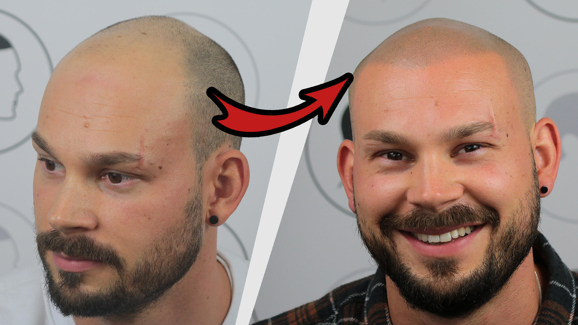 Kundenfoto 6 Haarpigmentierung | Modern Hair Loss Solution