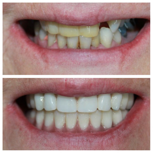 Before & After Results at White Pine Dental | Herriman, UT
