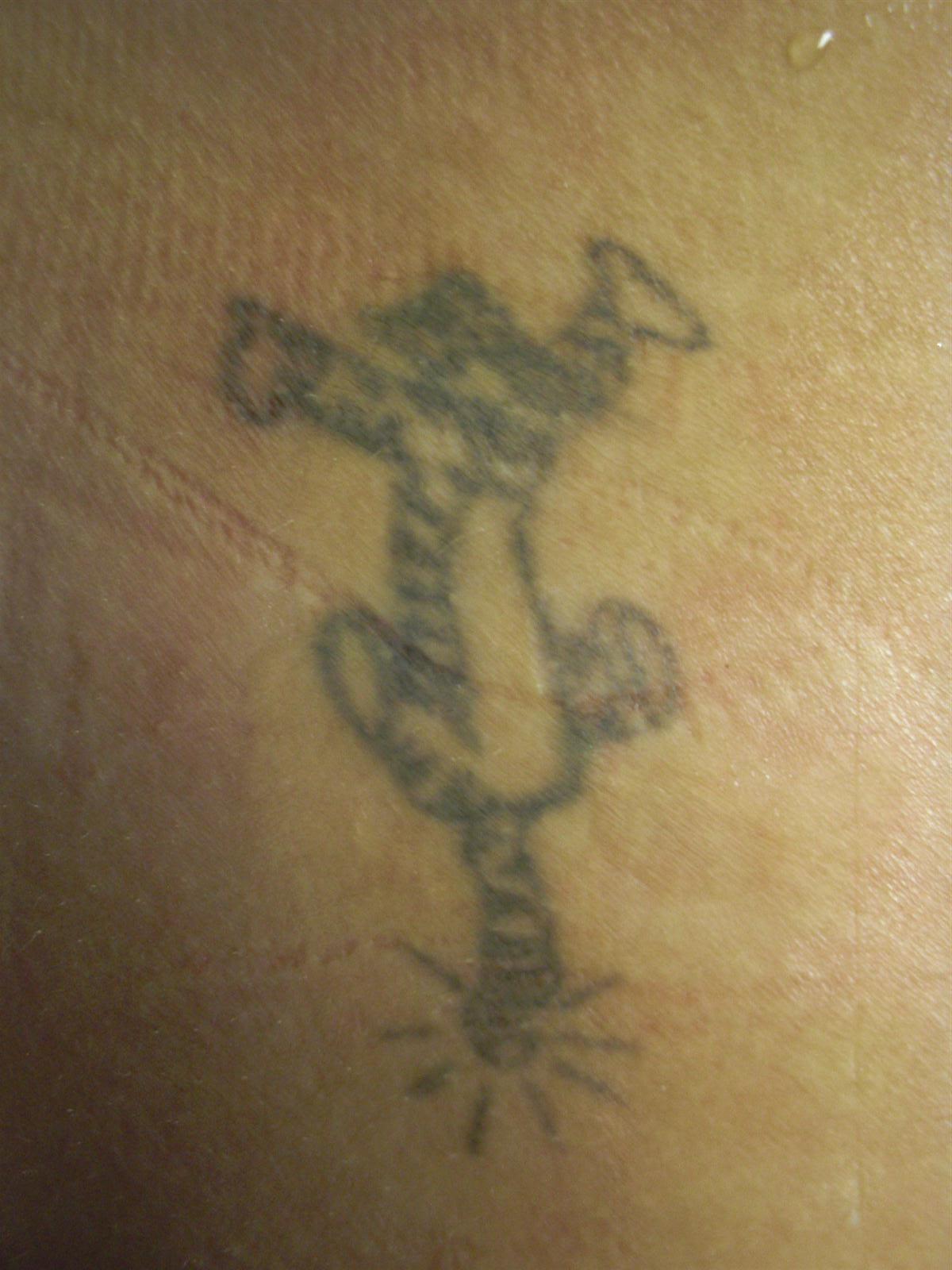 MEDermis Laser Tattoo Removal in San Antonio, TX 78258 