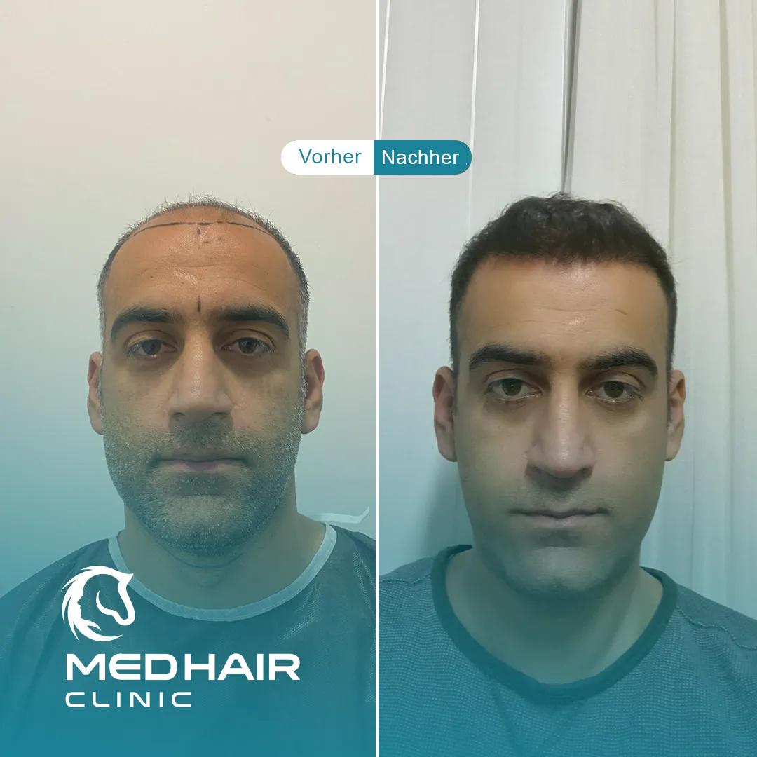 MedHair Clinic | Haartransplantationen in der Türkei Istanbul, Höninger Weg 176 in Rodenkirchen