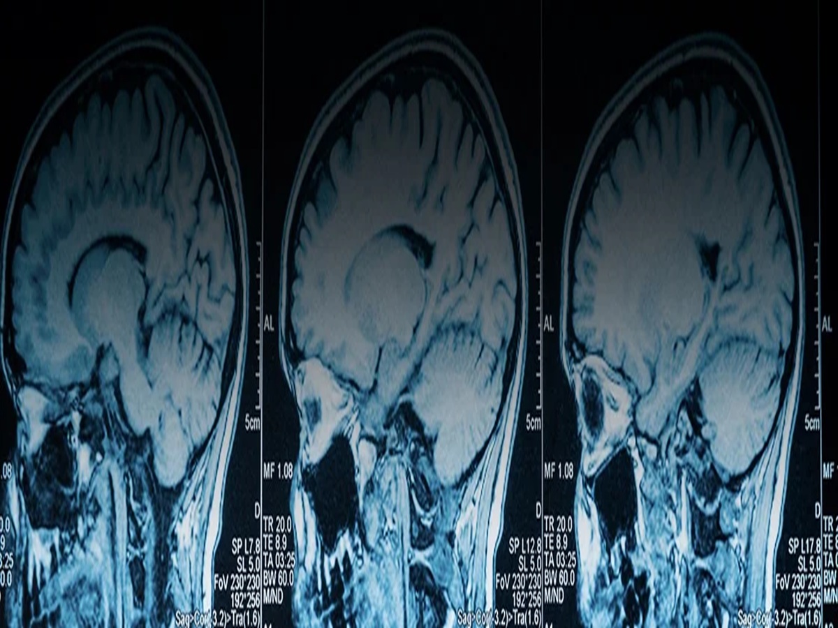Brain Injury Attorney Orlando FL 32804 