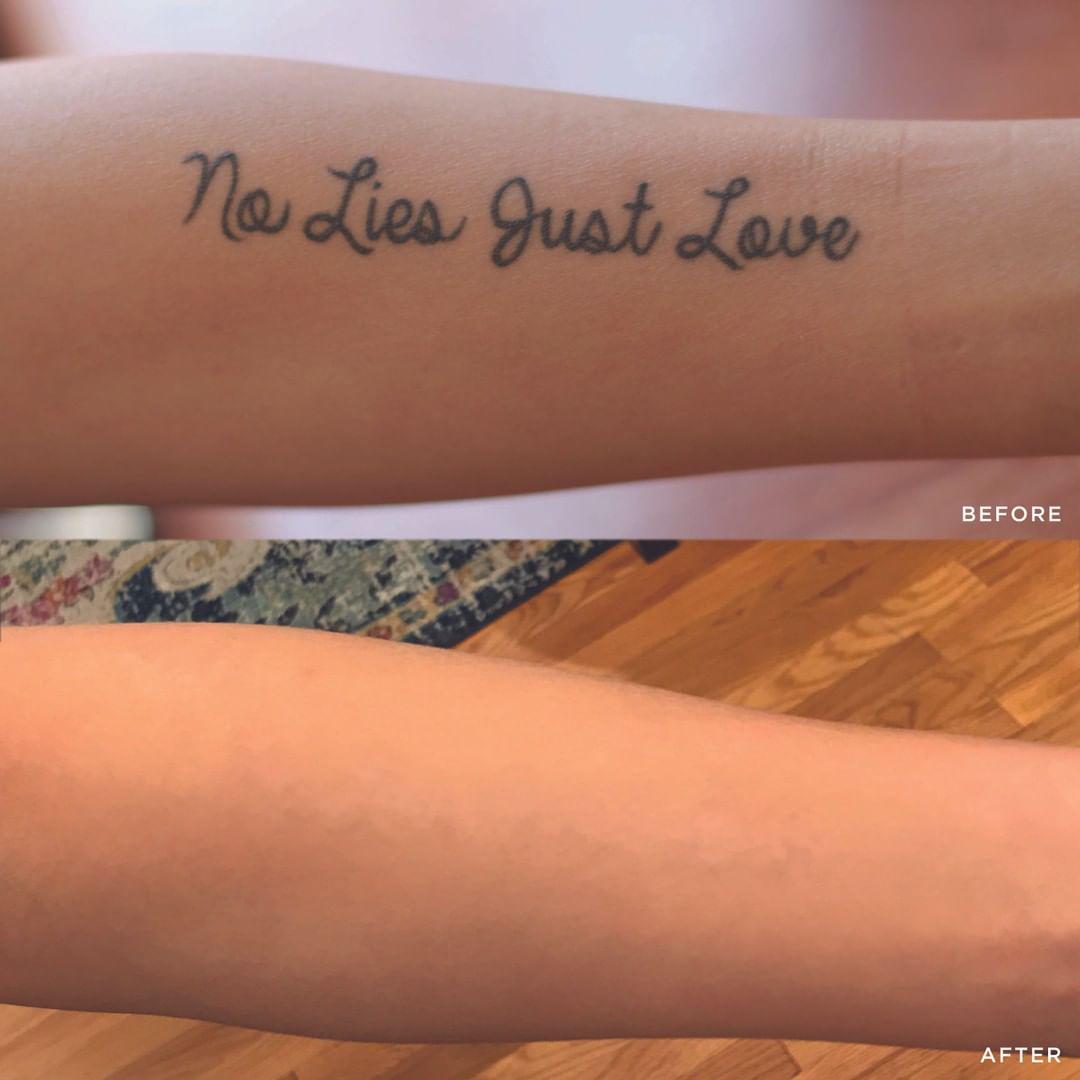 Removery Tattoo Removal & Fading in Ottawa: Before & After Forearm Tattoo Removal