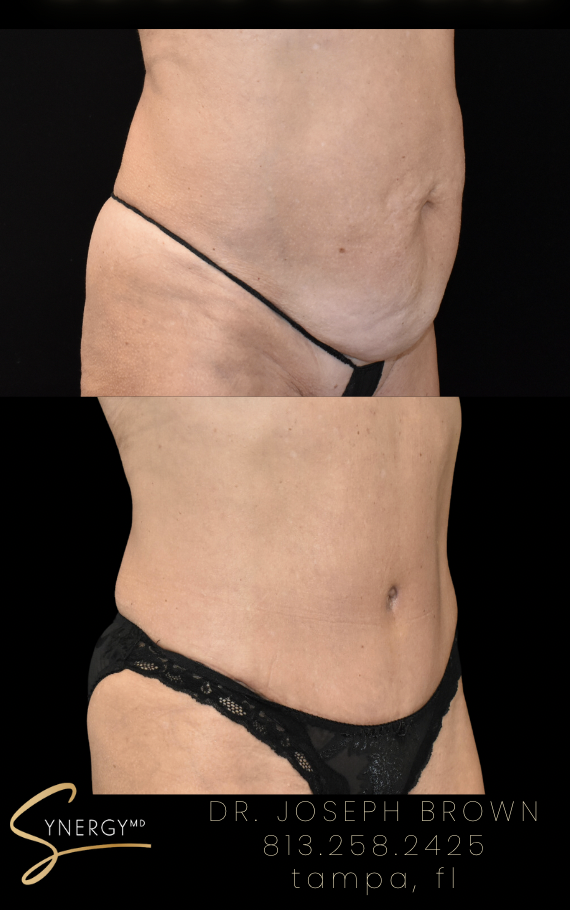 Before & After from SynergyMD Plastic Surgery | Tampa, FL