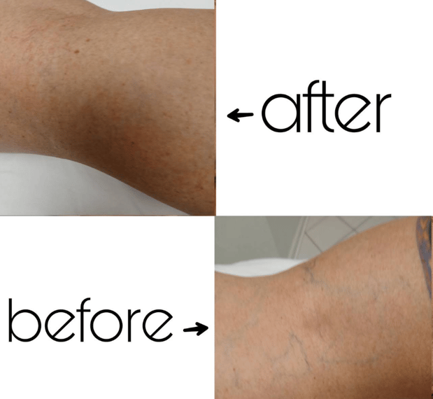 Images Laser Hair Removal in Churchville, NY