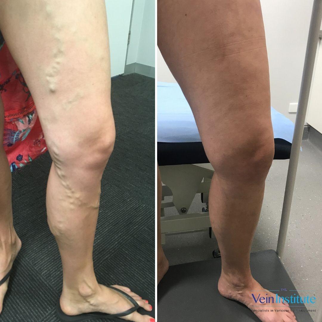 Images The Vein Institute Sydney - Varicose Vein Specialists
