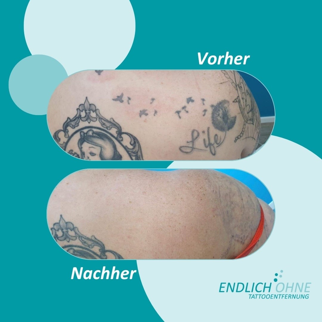 Bilder ENDLICH OHNE Tattooentfernung Filiale Mannheim