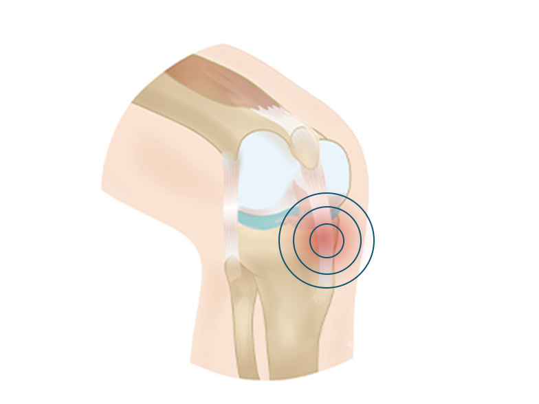 Cncrns_Cndtns-kneepain-below-392x294@2x.jpg