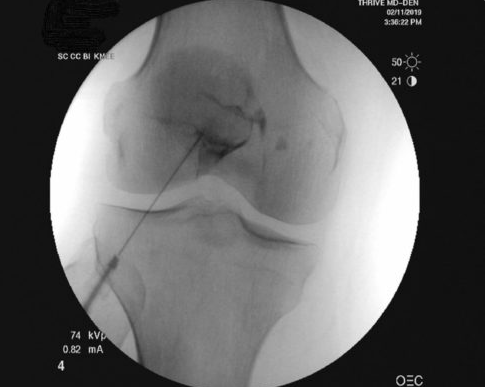 Placement of a subpatellar stem cell injection in a patient with lateral patella-femoral arthritis