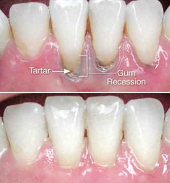 Before and After from Batista Family Dental | West New York, NJ