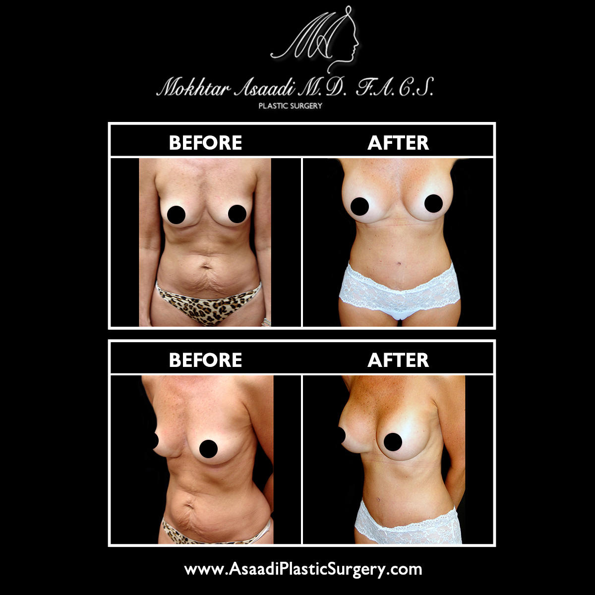 Breast augmentation surgery in New Jersey can help enhance the size, shape, and symmetry of the breasts. Dr. Asaadi will only use saline implants for breast augmentation surgery and utilizes the inframammary incision for the most natural-looking results.