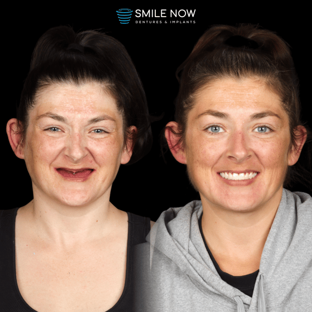 Images Smile Now Colorado Springs Dentures and Implants