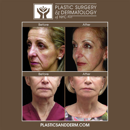 Facial rejuvenation surgery is one of the leading procedures to reduce the signs of aging. Facelift tightens loose skin, reducing creases, sagging, and wrinkles around the cheeks, eyes, mouth, and forehead. Dr. Levine emphasizes a personalized approach to facial surgery to ensure the appearance of a natural-looking restored youthfulness.