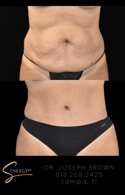 Before & After from SynergyMD Plastic Surgery | Tampa, FL