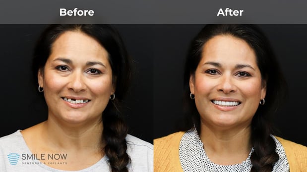 Images Smile Now Eugene Dentures and Implants