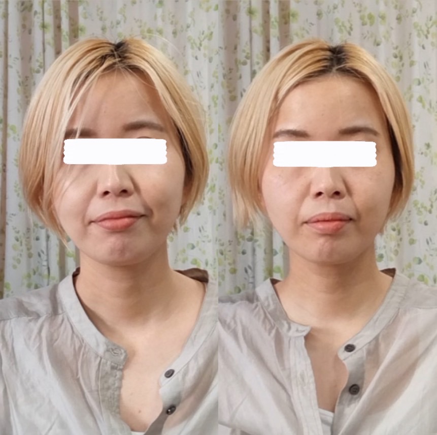 Images 目元・口元のたるみ&眉間シワ改善専門サロン