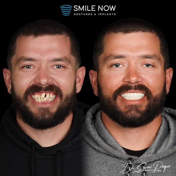 Images Smile Now Denver Dentures and Implants