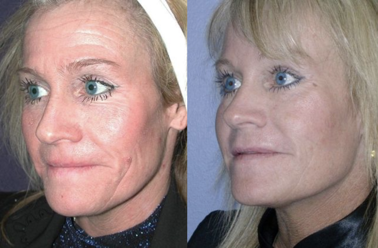 Before and after at Lowe Plastic Surgery | Oklahoma City, OK