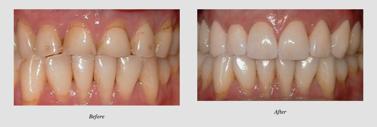 Porcelain Crown Before & After from Hawaii Pacific Dental Group, Inc. | Honolulu, HI