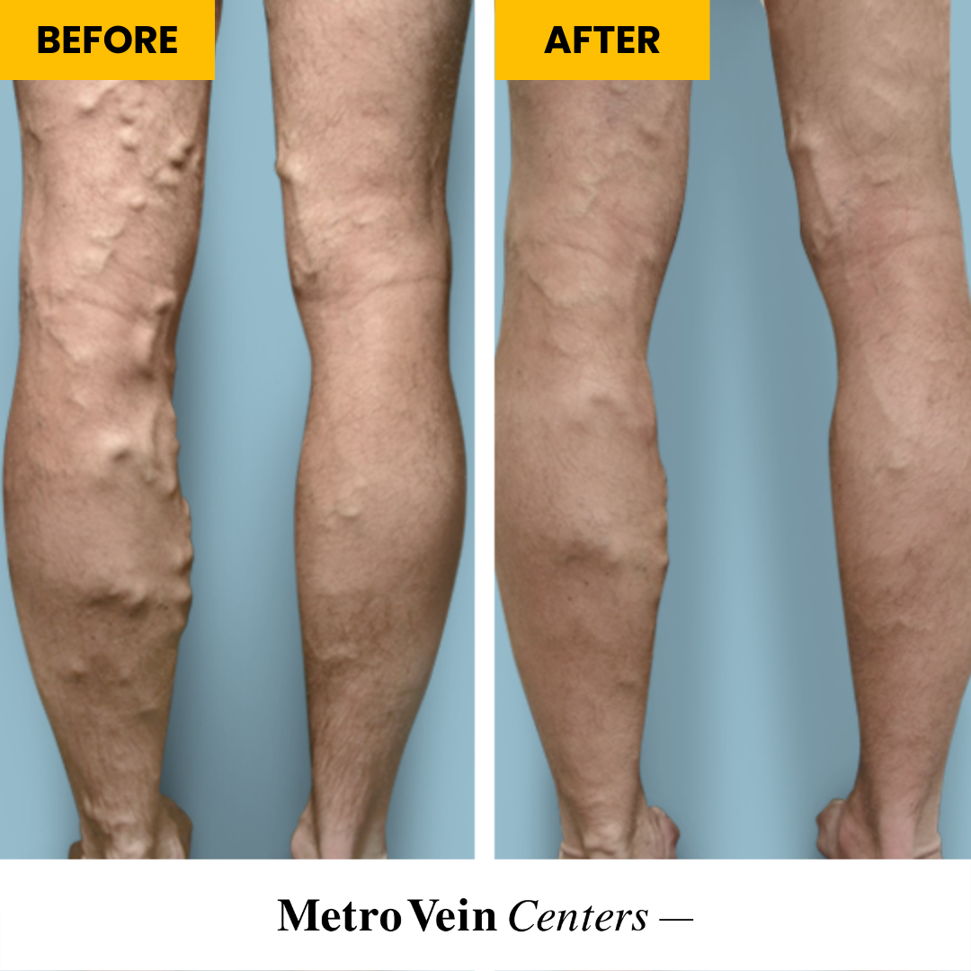 Before and after: varicose vein removal results. We offer a variety of varicose vein treatments, done in under 15 minutes!