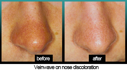 Image 9 | Laser Lipo and Vein Center