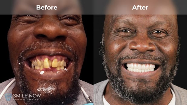 Images Smile Now Milwaukee Dentures and Implants