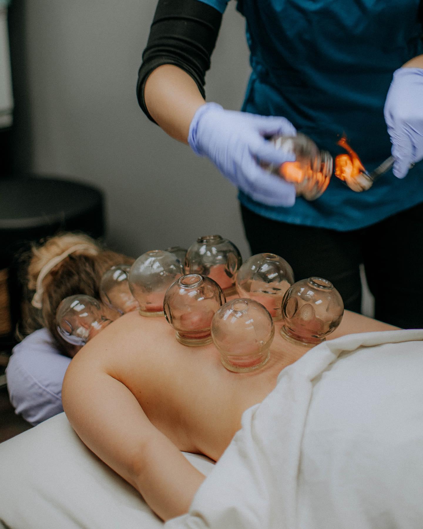 Cupping at One Agora Integrative Health in Bloomington MN