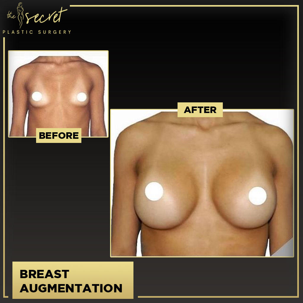 Breast Augmentation - The Secret Plastic Surgery