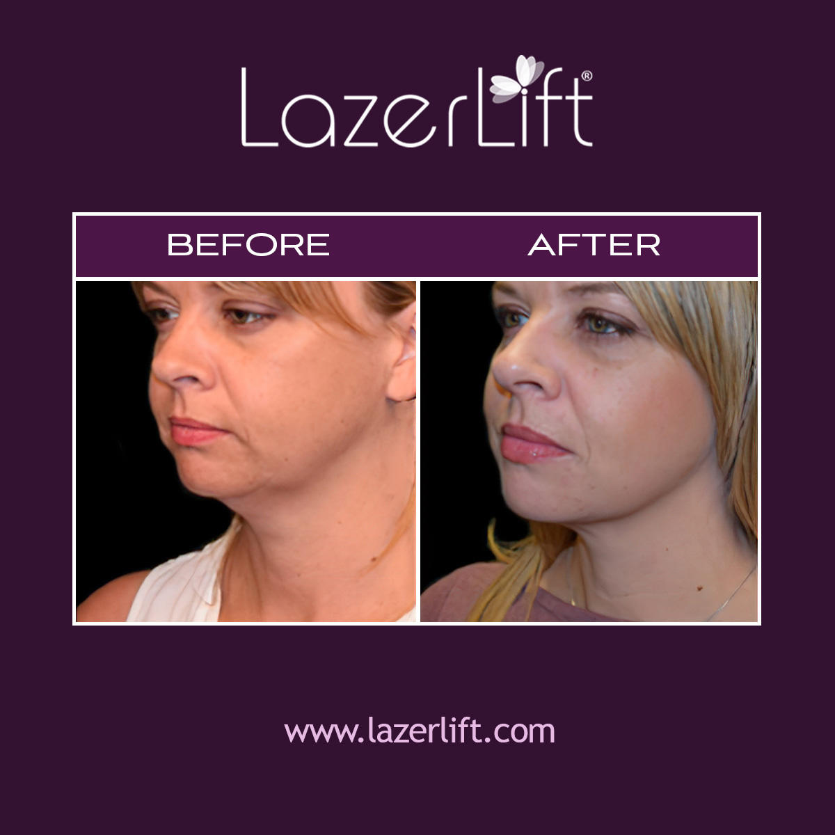 Our facial plastic surgeons in Tampa provide patients with transformative facelift results using LazerLift® technology. The LazerLift® facelift targets the mid-to-lower face to create a youthful look and reverse the signs of aging. LazaerLift® is the minimally-invasive solution to reduce wrinkles, eliminate turkey neck, sculpt the jawline, and more.