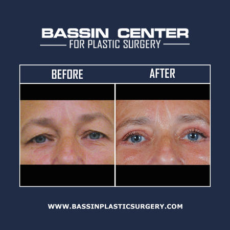 Dr. Bassin & his talented team of facial rejuvenation experts can reduce the signs of aging through a variety of surgical & non-surgical facial treatments. Facelift surgery, rhinoplasty, brow lift surgery, blepharoplasty, cheek lift surgery, & LazerLift™ can be performed for patients looking to achieve long-lasting improvements to their facial profile. Bassin Plastic Surgery also offers cosmetic injectables to achieve natural-looking results with little-to-no downtime.